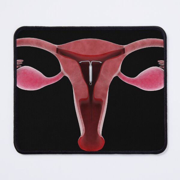 Item preview, STK701381H-An intrauterine device in position inside the female uterus. designed and sold by StocktrekImages.