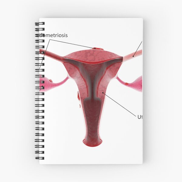 Item preview, STK701383H-Female reproductive organ with endometriosis. designed and sold by StocktrekImages.