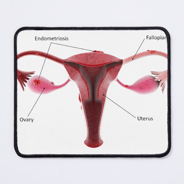 Item preview, STK701383H-Female reproductive organ with endometriosis. designed and sold by StocktrekImages.