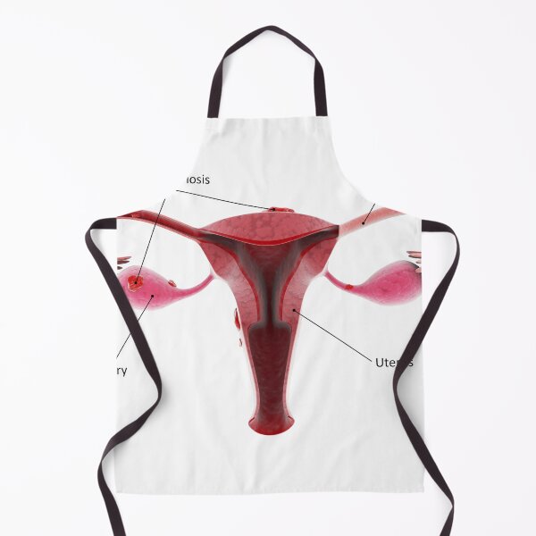 Item preview, STK701383H-Female reproductive organ with endometriosis. designed and sold by StocktrekImages.