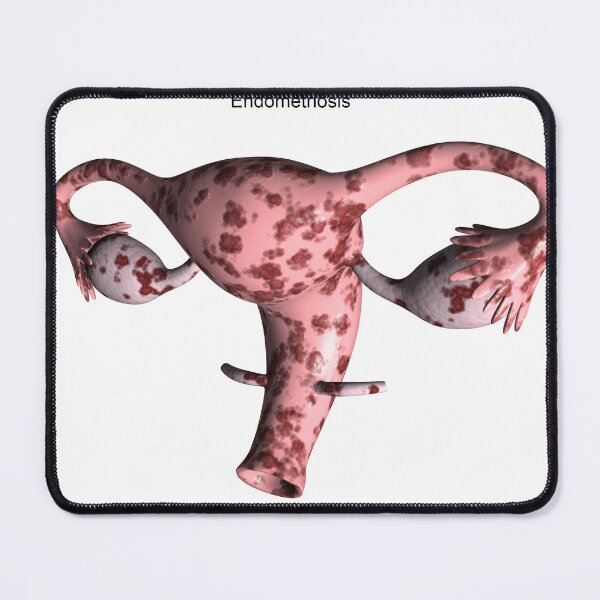 Item preview, STK701384H-Female reproductive organ with endometriosis. designed and sold by StocktrekImages.