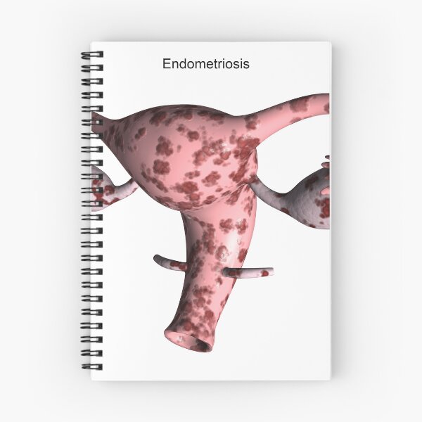 Item preview, STK701384H-Female reproductive organ with endometriosis. designed and sold by StocktrekImages.