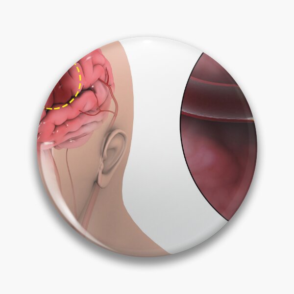 Item preview, STK701385H-An ischemic stroke. designed and sold by StocktrekImages.
