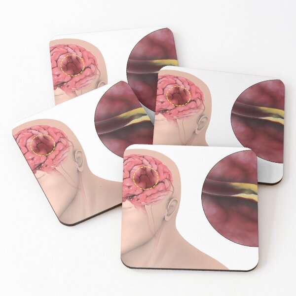Item preview, STK701385H-An ischemic stroke. designed and sold by StocktrekImages.