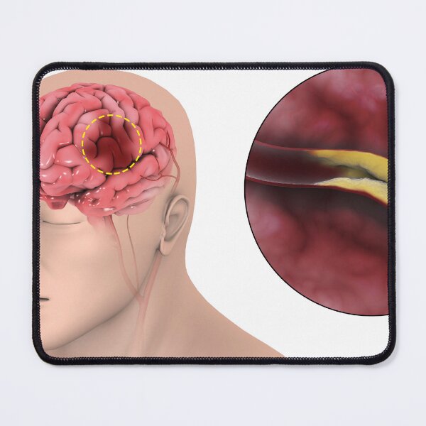 Item preview, STK701385H-An ischemic stroke. designed and sold by StocktrekImages.