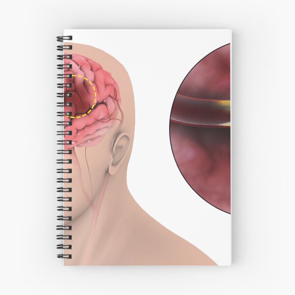 Item preview, STK701385H-An ischemic stroke. designed and sold by StocktrekImages.