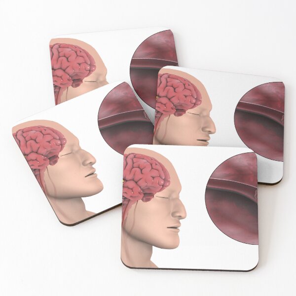 Item preview, STK701386H-An ischemic stroke. designed and sold by StocktrekImages.
