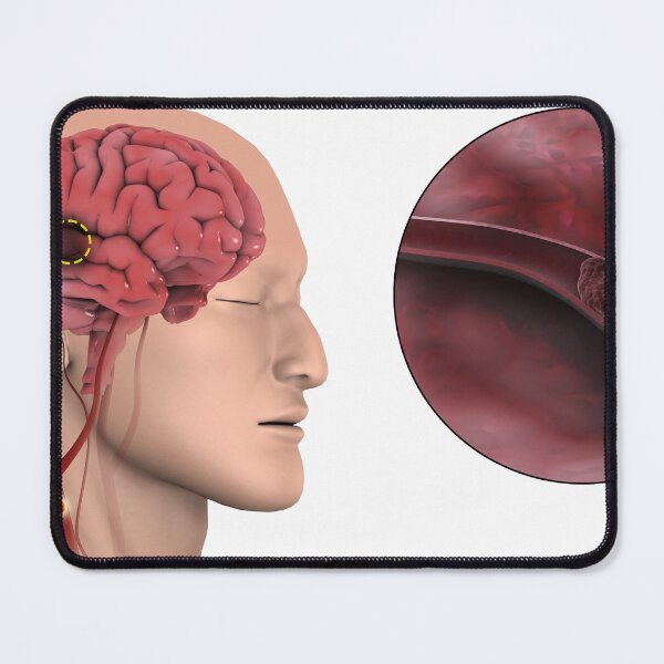 Item preview, STK701386H-An ischemic stroke. designed and sold by StocktrekImages.