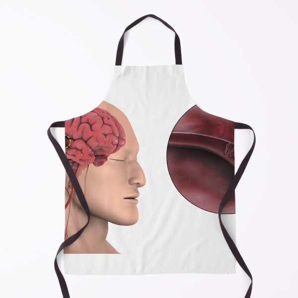 Item preview, STK701386H-An ischemic stroke. designed and sold by StocktrekImages.