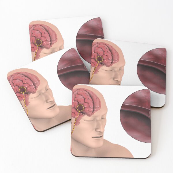 Item preview, STK701387H-An ischemic stroke. designed and sold by StocktrekImages.
