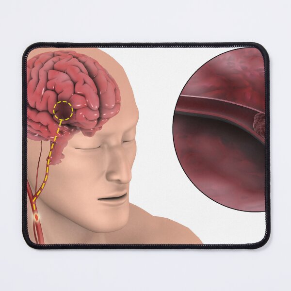 Item preview, STK701387H-An ischemic stroke. designed and sold by StocktrekImages.