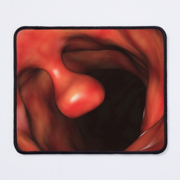 Item preview, STK701391H-Close-up of a colon polyp. designed and sold by StocktrekImages.