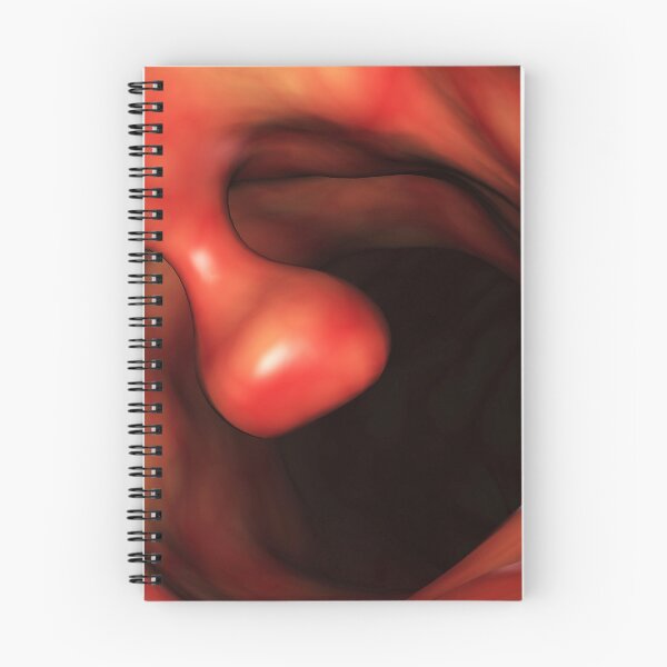 Item preview, STK701391H-Close-up of a colon polyp. designed and sold by StocktrekImages.