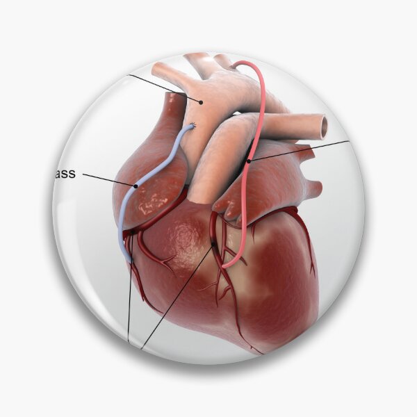 Item preview, STK701392H-Coronary artery bypass of the human heart. designed and sold by StocktrekImages.