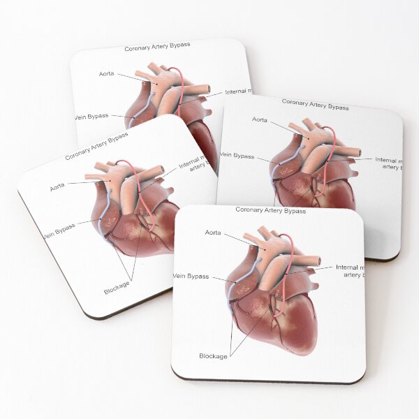 Item preview, STK701392H-Coronary artery bypass of the human heart. designed and sold by StocktrekImages.