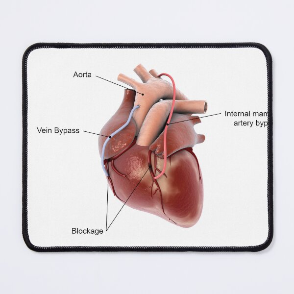 Item preview, STK701392H-Coronary artery bypass of the human heart. designed and sold by StocktrekImages.