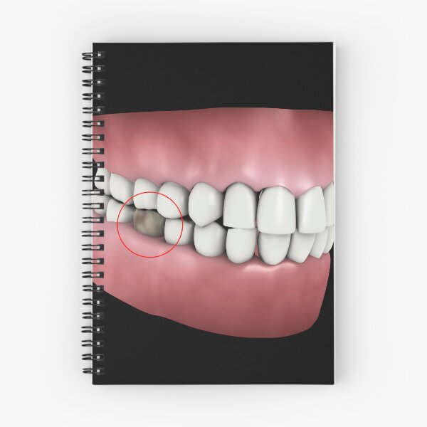 Item preview, STK701393H-Tooth cavity. designed and sold by StocktrekImages.