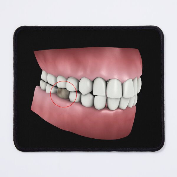 Item preview, STK701393H-Tooth cavity. designed and sold by StocktrekImages.
