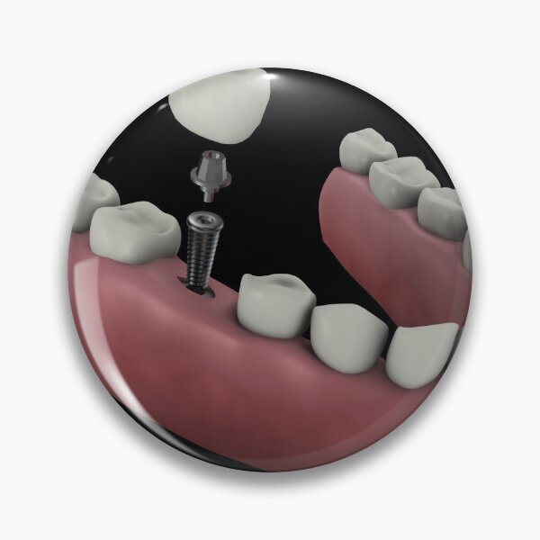 Item preview, STK701394H-Tooth implant. designed and sold by StocktrekImages.