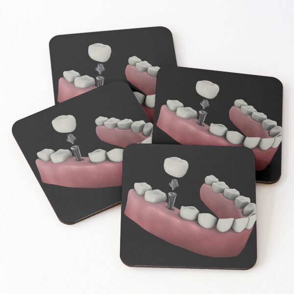 Item preview, STK701394H-Tooth implant. designed and sold by StocktrekImages.