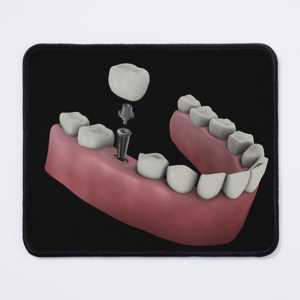 Item preview, STK701394H-Tooth implant. designed and sold by StocktrekImages.