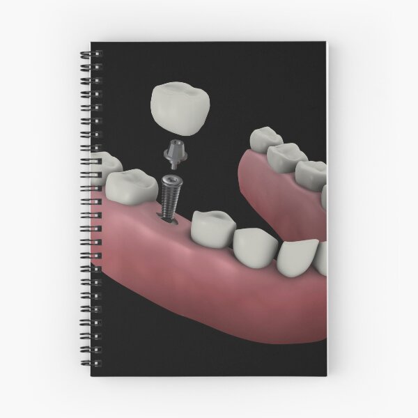 Item preview, STK701394H-Tooth implant. designed and sold by StocktrekImages.