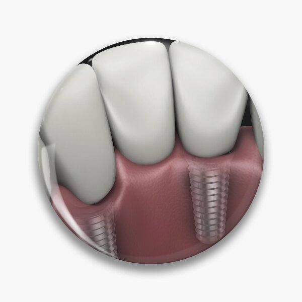 Item preview, STK701395H-Tooth implant. designed and sold by StocktrekImages.