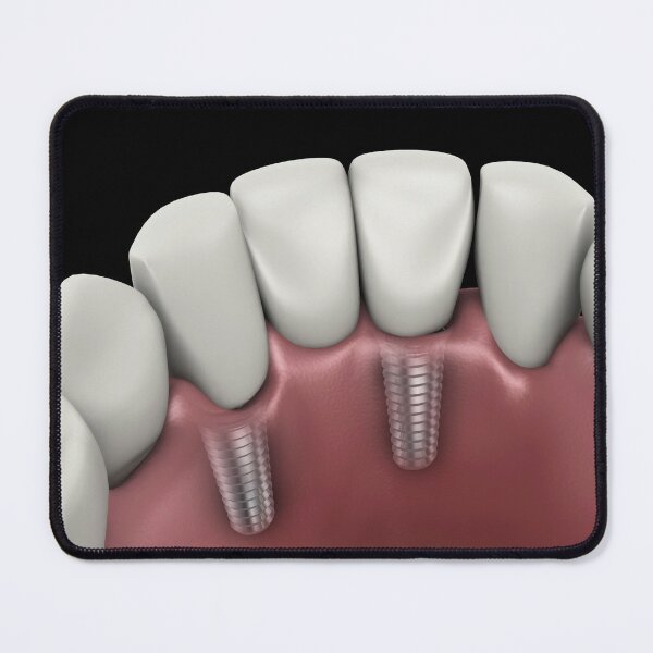 Item preview, STK701395H-Tooth implant. designed and sold by StocktrekImages.