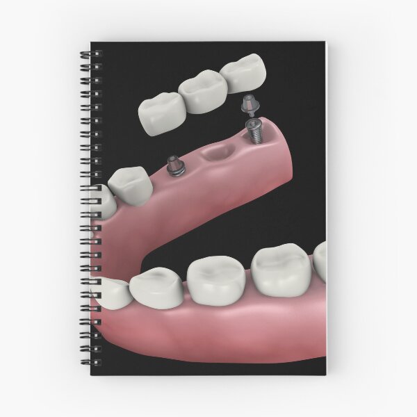 Item preview, STK701396H-A dental bridge. designed and sold by StocktrekImages.
