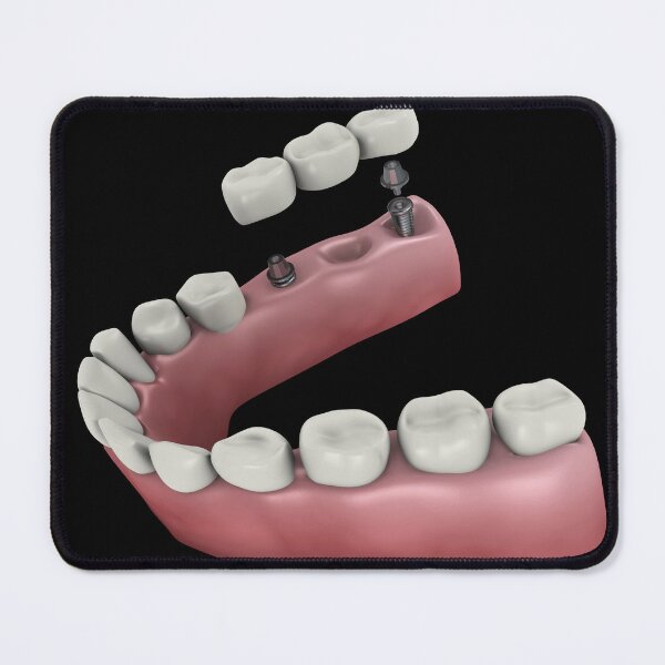 Item preview, STK701397H-A dental bridge. designed and sold by StocktrekImages.