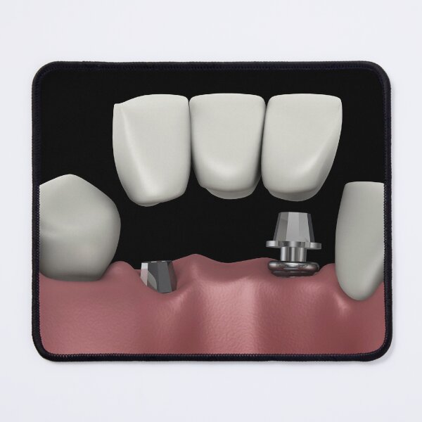 Item preview, STK701398H-A dental bridge. designed and sold by StocktrekImages.