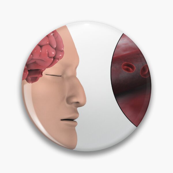 Item preview, STK701406H-Hemorrhagic stroke in the brain. designed and sold by StocktrekImages.