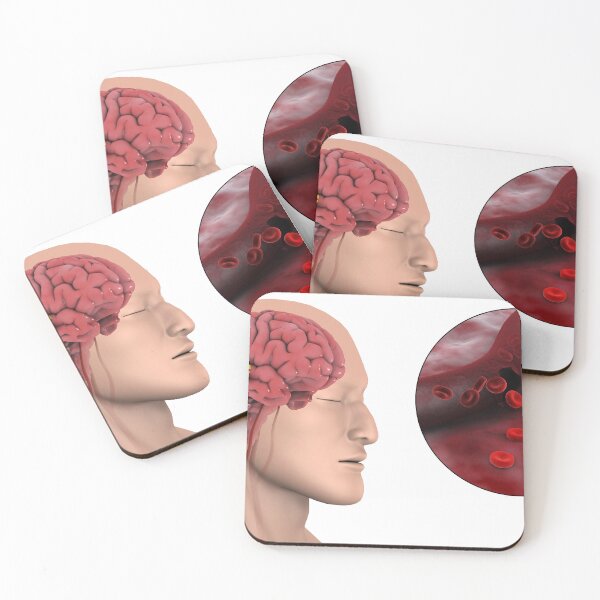 Item preview, STK701406H-Hemorrhagic stroke in the brain. designed and sold by StocktrekImages.