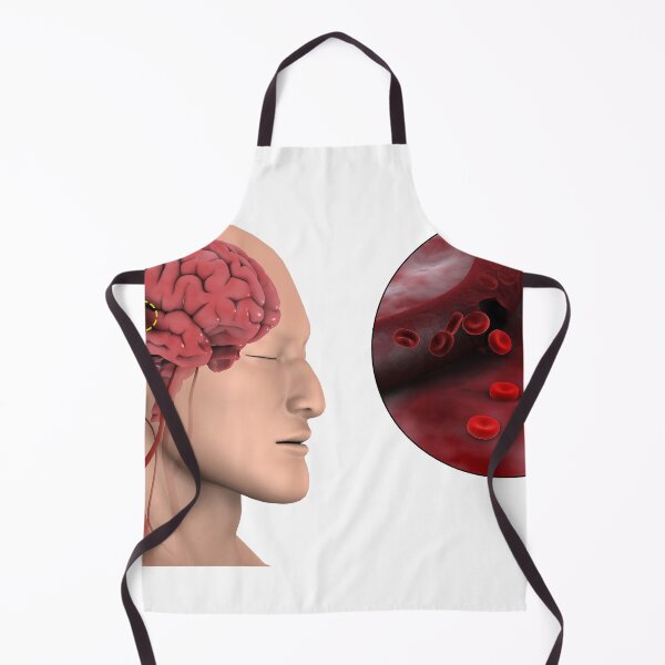Item preview, STK701406H-Hemorrhagic stroke in the brain. designed and sold by StocktrekImages.