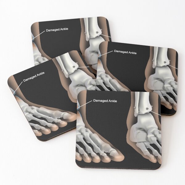 Item preview, STK701407H-Ankle fusion illustration designed and sold by StocktrekImages.