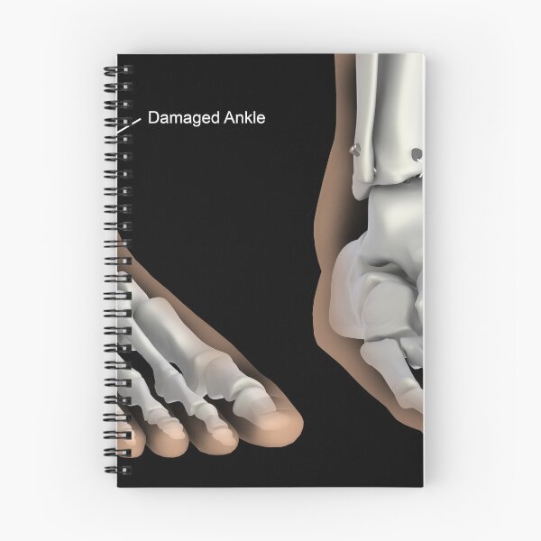 Item preview, STK701407H-Ankle fusion illustration designed and sold by StocktrekImages.