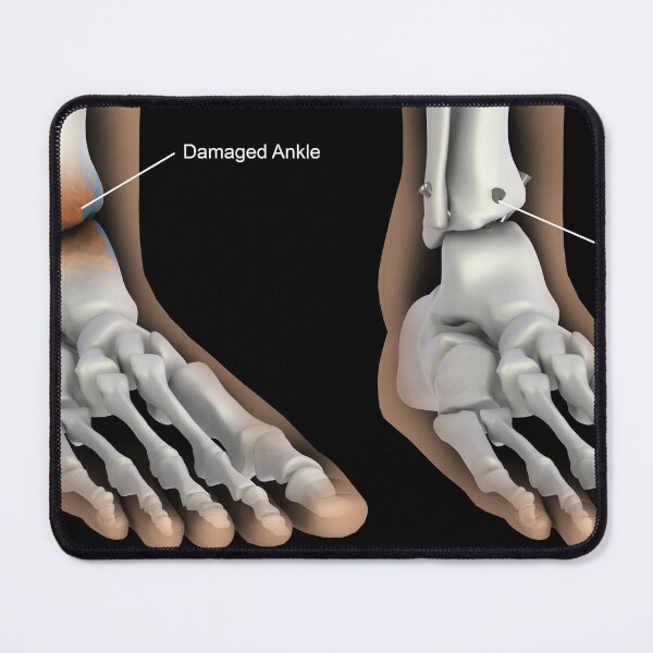 Item preview, STK701407H-Ankle fusion illustration designed and sold by StocktrekImages.