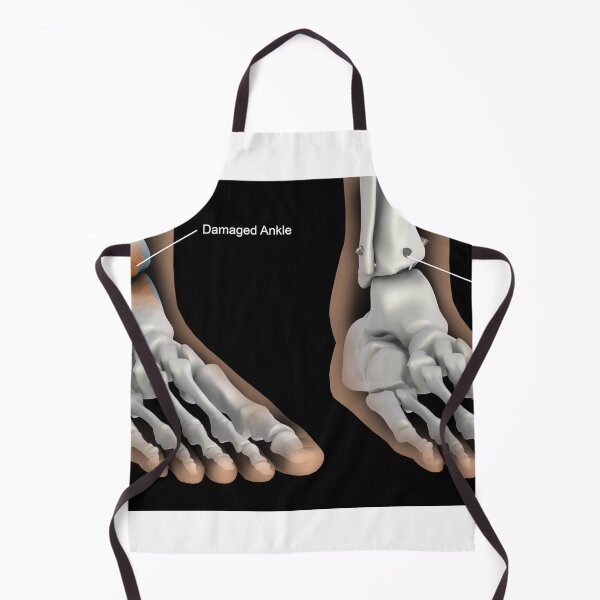 Item preview, STK701407H-Ankle fusion illustration designed and sold by StocktrekImages.
