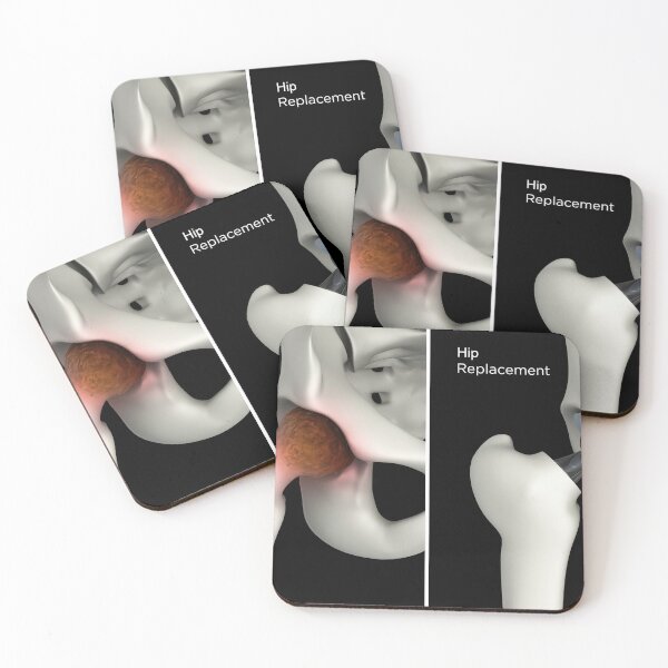 Item preview, STK701408H-Hip replacement of a damaged hip. designed and sold by StocktrekImages.