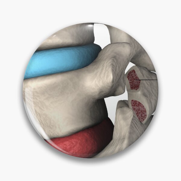 Item preview, STK701411H-Spondylolisthesis and spondylolysis in the human vertebra. designed and sold by StocktrekImages.