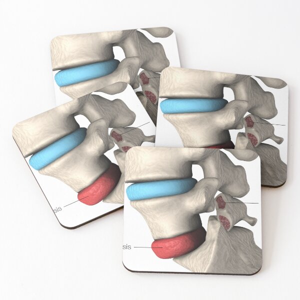 Item preview, STK701411H-Spondylolisthesis and spondylolysis in the human vertebra. designed and sold by StocktrekImages.