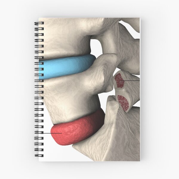 Item preview, STK701411H-Spondylolisthesis and spondylolysis in the human vertebra. designed and sold by StocktrekImages.