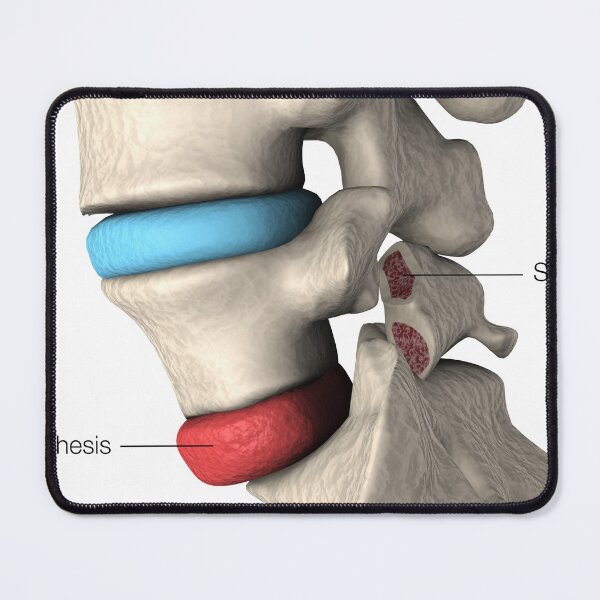 Item preview, STK701411H-Spondylolisthesis and spondylolysis in the human vertebra. designed and sold by StocktrekImages.