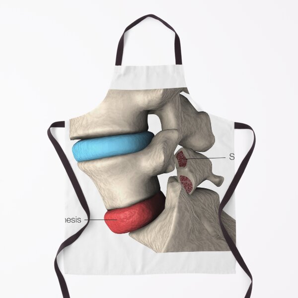 Item preview, STK701411H-Spondylolisthesis and spondylolysis in the human vertebra. designed and sold by StocktrekImages.