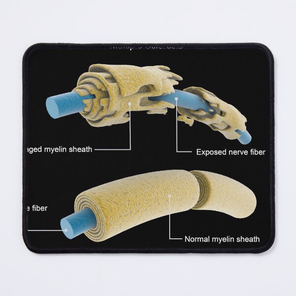 Item preview, STK701418H-Multiple sclerosis neuron compared to a normal neuron. designed and sold by StocktrekImages.
