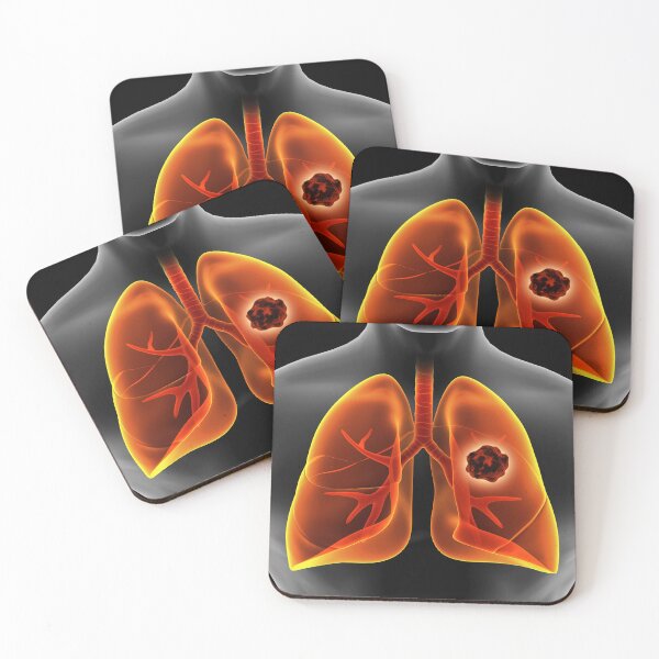 Item preview, STK701432H-Lung cancer inside the human lungs. designed and sold by StocktrekImages.