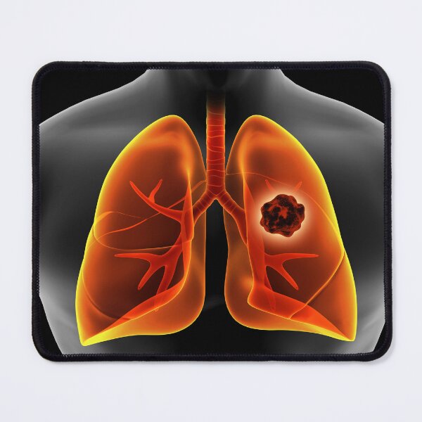 Item preview, STK701432H-Lung cancer inside the human lungs. designed and sold by StocktrekImages.