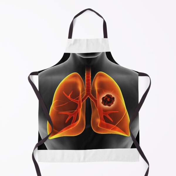 Item preview, STK701432H-Lung cancer inside the human lungs. designed and sold by StocktrekImages.