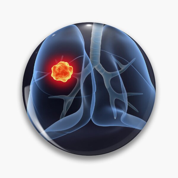 Item preview, STK701433H-Lung cancer inside the human lungs. designed and sold by StocktrekImages.