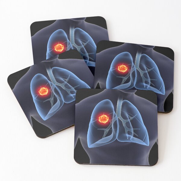Item preview, STK701433H-Lung cancer inside the human lungs. designed and sold by StocktrekImages.